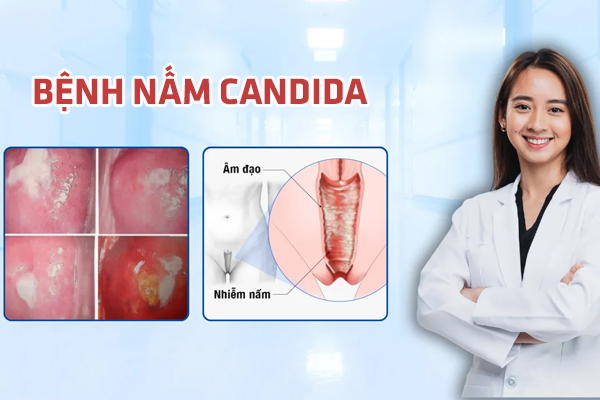 Nấm Candida - Nguyên nhân, dấu hiệu và cách chữa trị hiệu quả