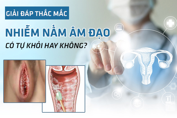 Nấm men âm đạo có tự khỏi không? Cần điều trị không?