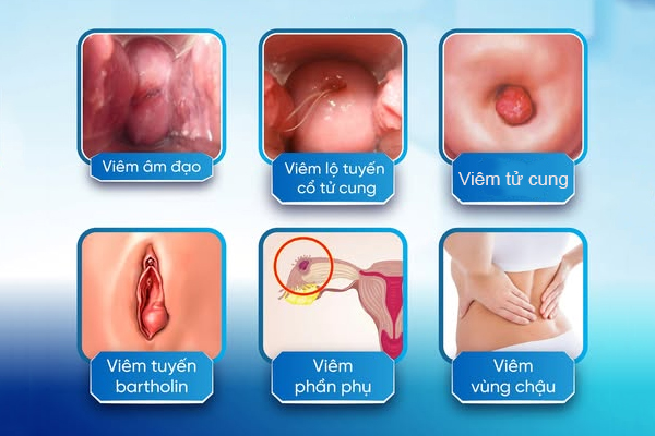 Tổng hợp các bệnh viêm phụ khoa nữ thường gặp