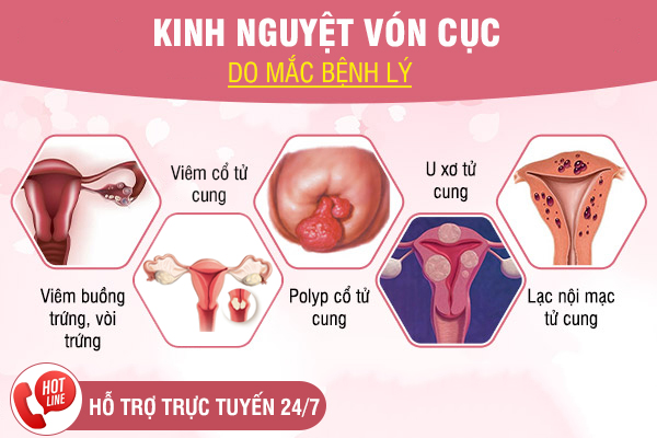 Kinh nguyệt vón cục có phải biểu hiện bất thường?